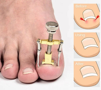 Ingrown Toenail Manicure Pedicure