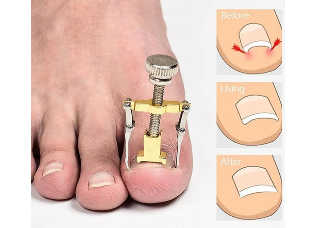 Ingrown Toenail Manicure Pedicure