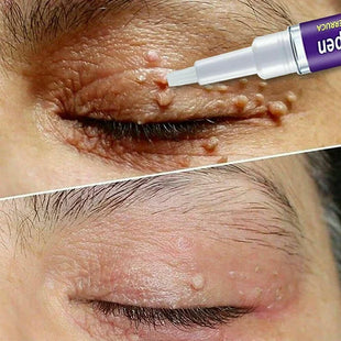 Wart Skin Tag Remover