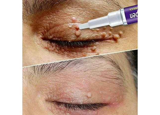 Wart Skin Tag Remover