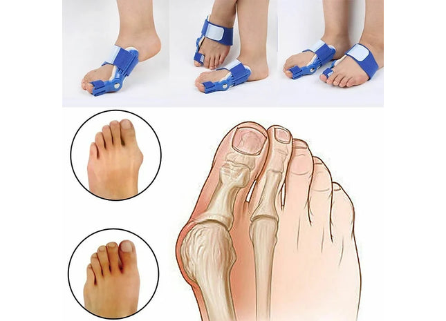 Orthopaedic Foot Bunion Correctors Pair